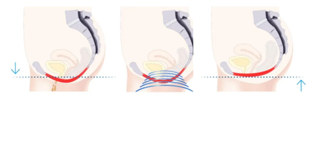 kegel throne works for women incontinence westrick clinic