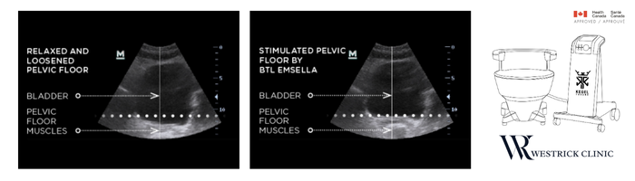 incontinence pelvic floor stimulation xray kegel throne Westrick Clinic - Emsella BTL