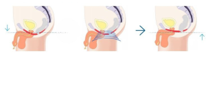 the kegel throne HFEIM Therapy Emsella for men westrick clinic
