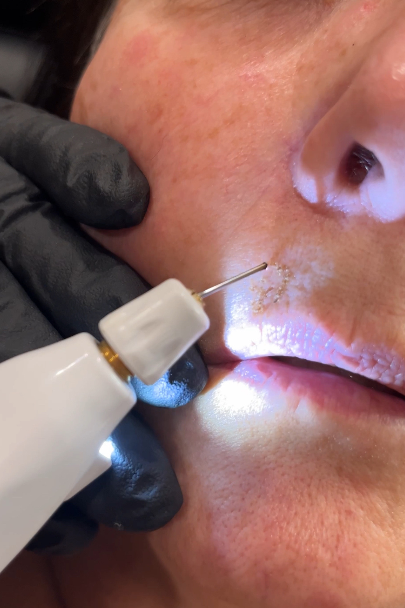 Plexr upper lip wrinkles Westrick Clinic 1 (1) | Westrick Clinic Westrick clinic neogen westrick clinic 1 (1)