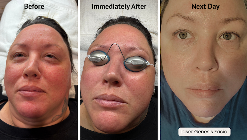 laser genesis facial next day westrick clinic