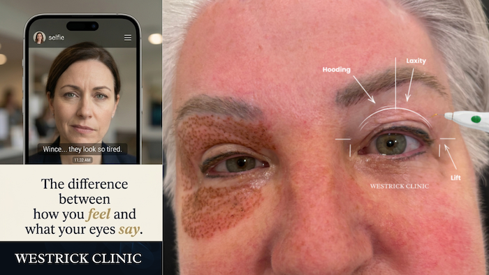 Westrick clinic westrick clinic plexr non-surgical eyelid tightening before and after results - westrick clinic