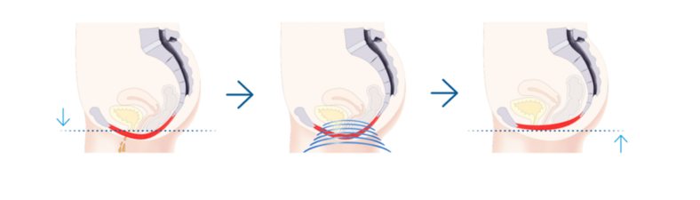 women kegel throne emsella chair contractions westrick clinic