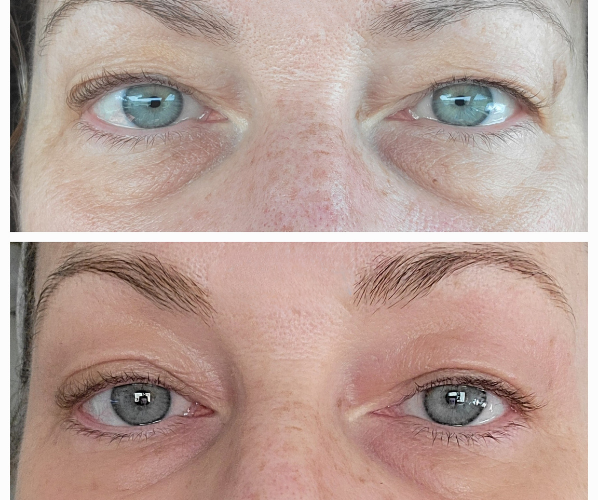 eye lid rejuvenation westrick clinic 1