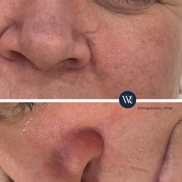 Westrick clinic westrick clinic spider vein nose removal westrick clinic