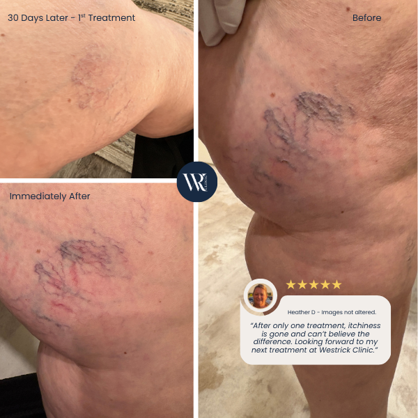 Westrick clinic westrick clinic collage showing a leg with varicose veins before and after treatment: right panel is the before image, left panels show immediate after and 30 days later with reduced veins and redness.