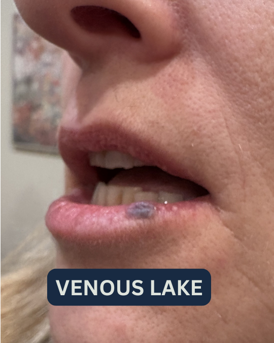 Westrick clinic westrick clinic venous lake treatment westrick clinic 1