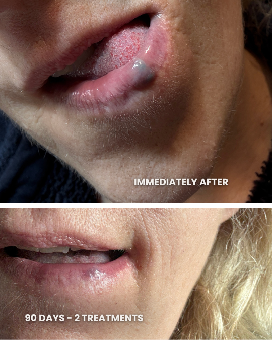 Westrick clinic westrick clinic two-panel close-up of a lip area: top image shows a red, crusted lip with the caption immediately after; bottom image shows smoother lip with the caption 90 days – 2 treatments.