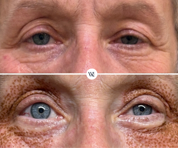eye lid rejuvenation westrick clinic 2026 plexr sue west rn