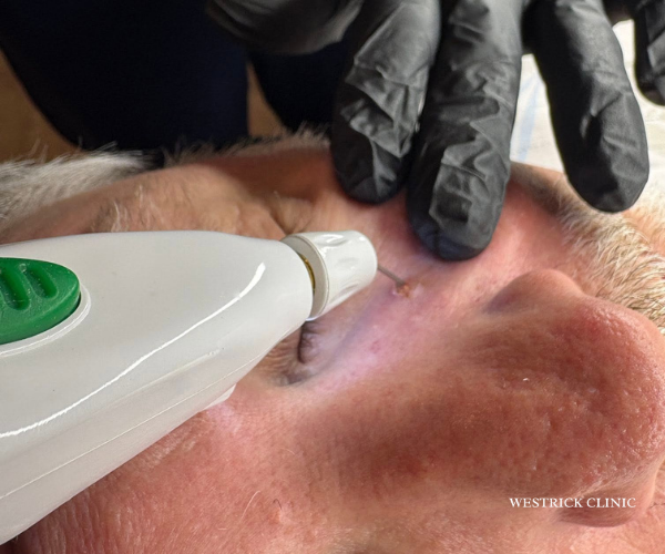 plexr lesion removal westrick clinic | Westrick Clinic Westrick clinic plexr lesion removal westrick clinic