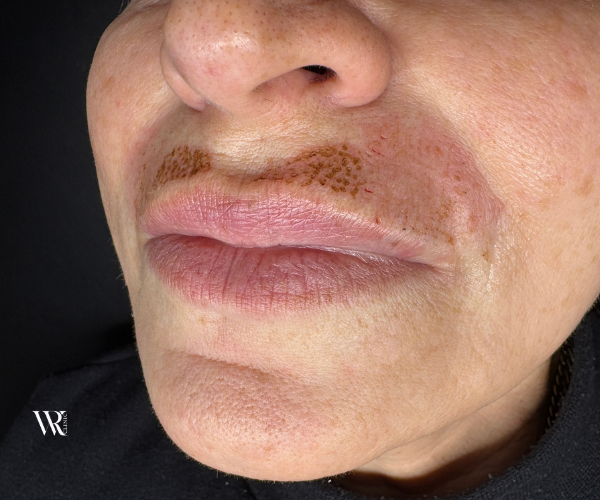 upper lip plexr rejuvenation tightening 2026 westrick clinic